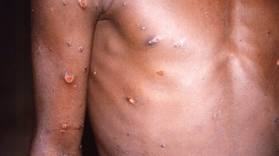 Monkeypox රෝගය රටවල් 11 ක -රෝගීන් 80 ක් තහවුරු වී ඇති බව WHO කියයි